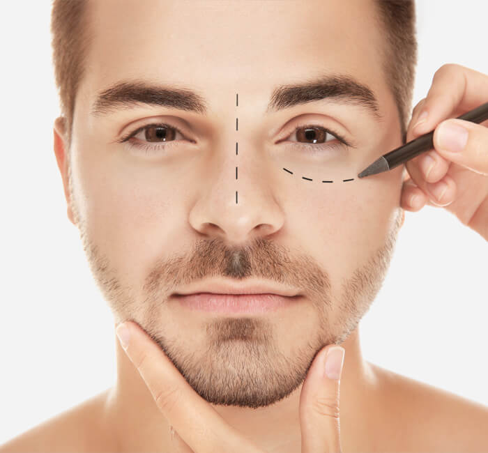 A man undergoing marking around eye, highlighting the male blepharoplasty procedure for improved appearance